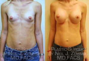 RichmondAestheticSurgery_BreastAug_Patient10