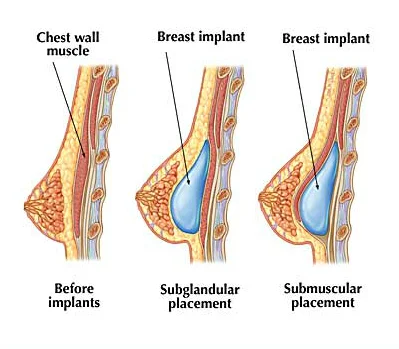Breast Implant Options and Choices in Richmond, Charlottesville, VA