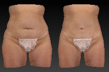 Body_Contouring_Animation_-_web_rd256