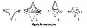 nipple_reconstruction