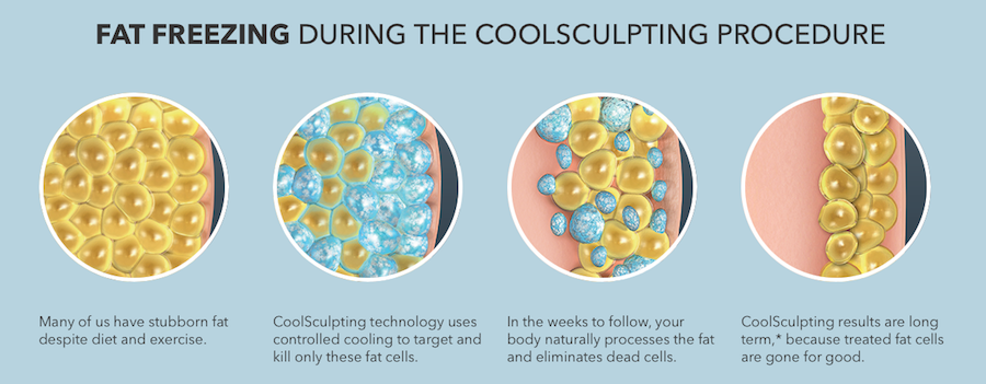 Fat Freezing During the Coolsculpting Procedure