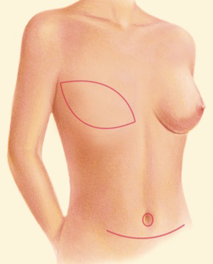 Breast Recon DIEP 1