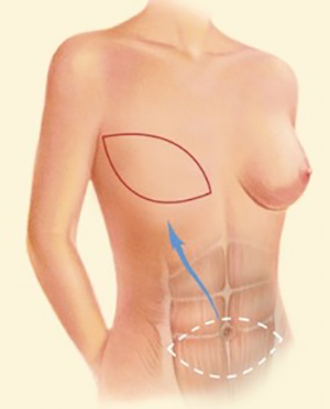 Breast Recon DIEP 2