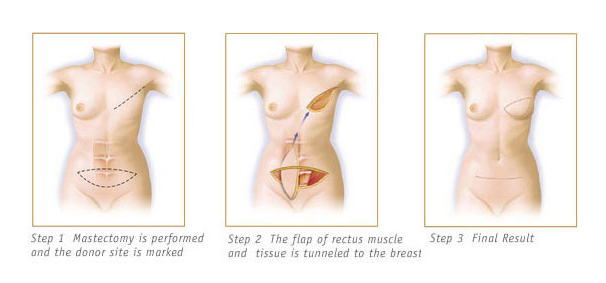 Breast Reconstruction Richmond Charlottesville VA