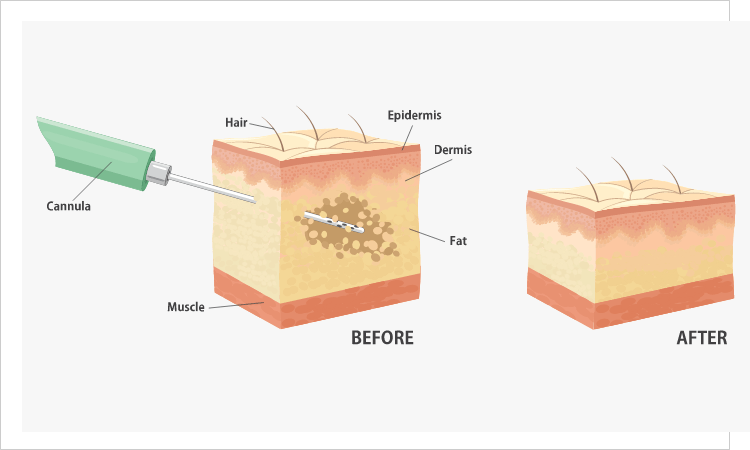 liposuction Illustration